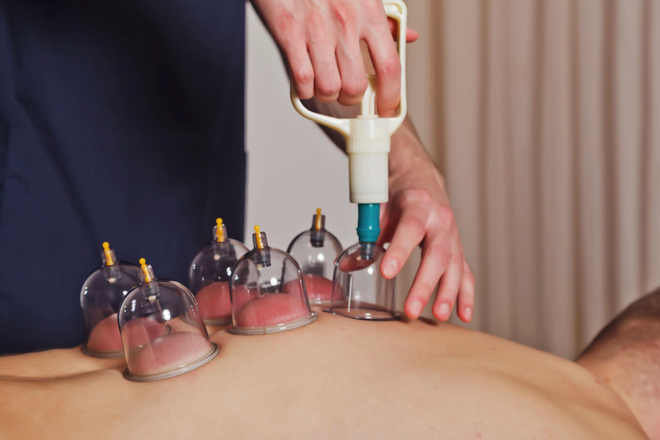 Cupping